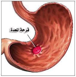 اعشاب لعلاج قرحة المعدة - اعشاب مفيده للمعدة 2218