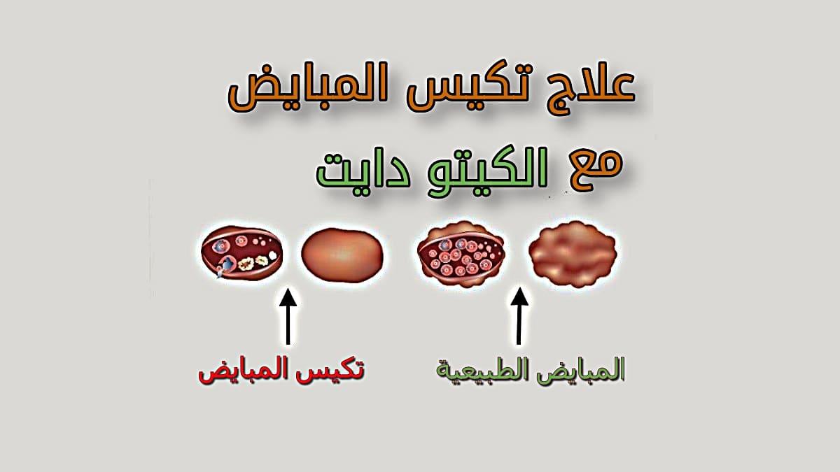 تكيس المبايض علاج - كل حاجة و ليها علاج