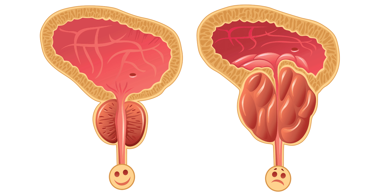 ما هو علاج تضخم البروستاتا , الرجال كبار السن بيشتكوا منها