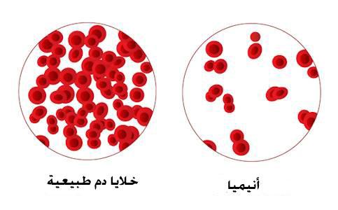 نتائج فقر الدم , وشك باين عليةتعالي تعرف تعمل اية