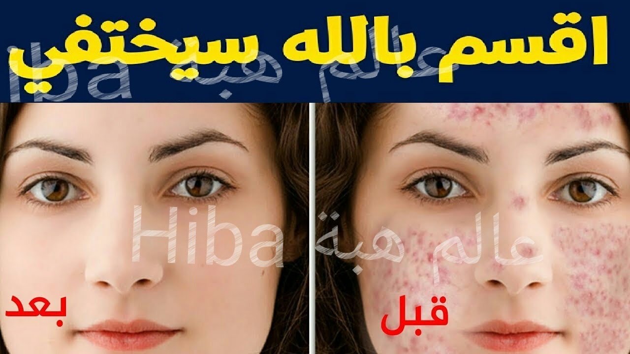 حبوب الانف الدهنية،طريقه طبيه في ازاله الحبوب الدهنيه وطريقه منزليه ابيض في هذه الازاله 9286 1