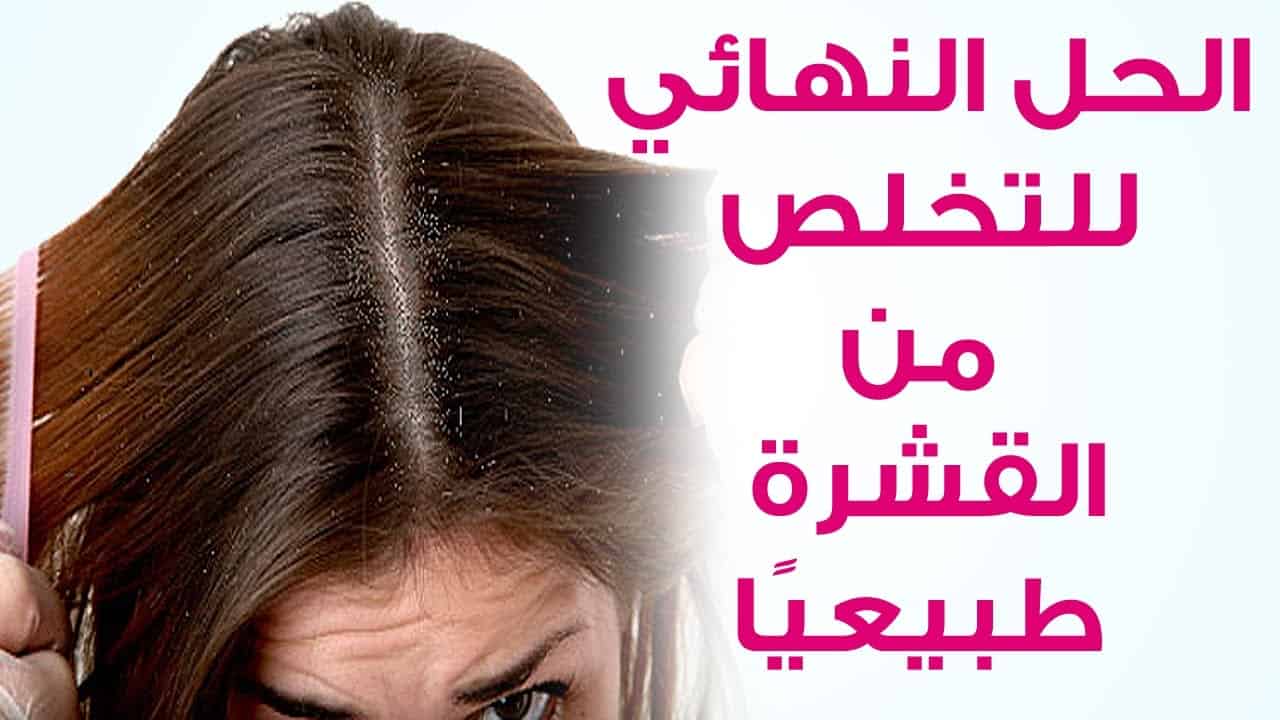 للتخلص من قشرة الشعر،تعريف قشره الشعر واسبابها وطرق العلاج منها 9250