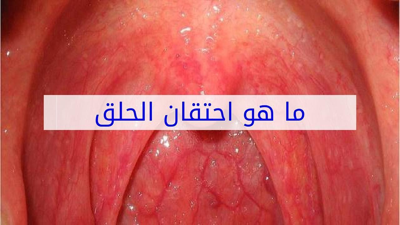 ما هو الاحتقان , صور مختلقه من الم الحلق