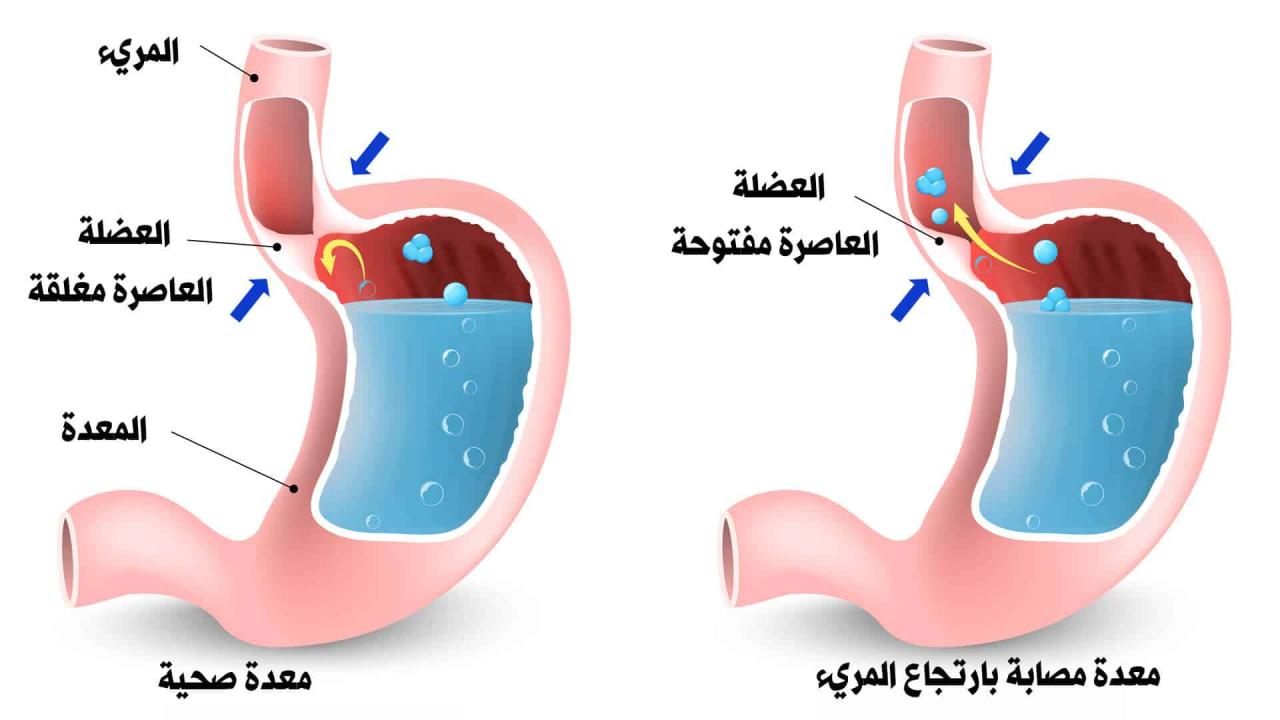 ما هو الارتجاع المريئي،تعريف الارتجاع المريء واعراضه 9129 2