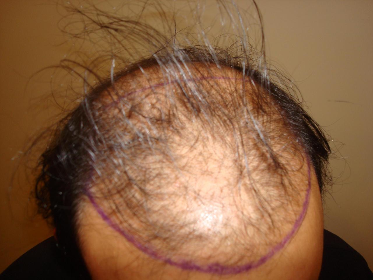 تجربتي مع زراعة الشعر , مش عيب ابدا بتحصل