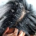 2824 2 وصفة للتخلص من قشرة الشعر - خلطة عجيبة تجعل شعرك خالي من القشور اجيال نصر