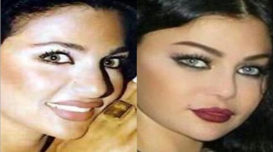 ممثلات كويتيات بعد التجميل بالعين يسد الغدد