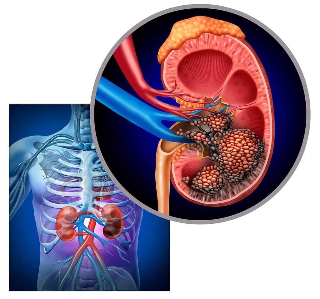 علاج سرطان الكلى - هل هناك علاج لسرطان الكلى فعلا 10038 1