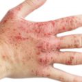 10048 1 اعراض الاكزيما في اليد - ما هي سبب جفاف الجلد بعد الاصابة بالاكزيما عايشه
